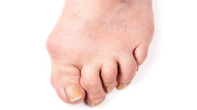 Rheumatoid polyarthritis on foot