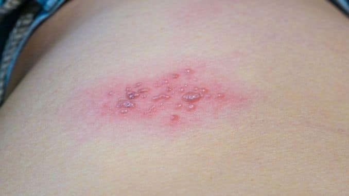 Blisters caused by shingles