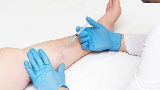 doctor-performs-sclerotherapy