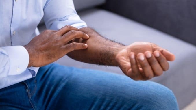 man-scratching-his-hand- Tips to Soothe Senior Itch