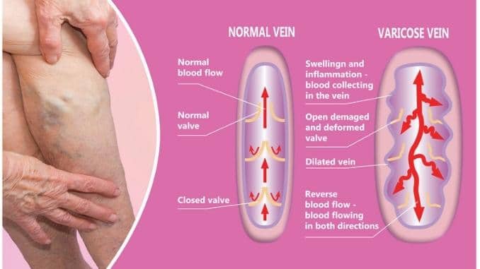 structure-normal-varicose-veins
