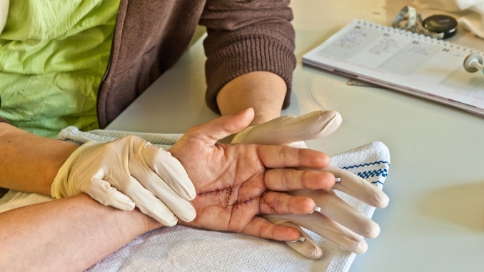 What is Hand Physical Therapy